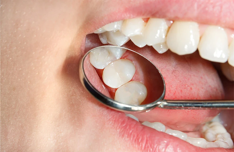 Tooth Colored Filling: Benefits, Procedure, Cost & Why It’s Better Than Silver Fillings