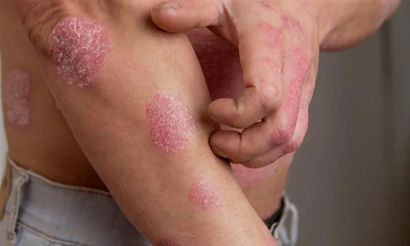 What dietary changes are recommended by doctors to treat psoriasis