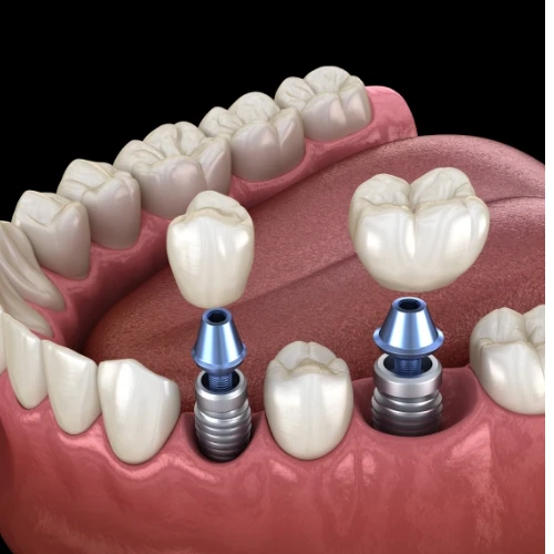 Dental Implants Explained: A Comprehensive Smile Restoration Guide