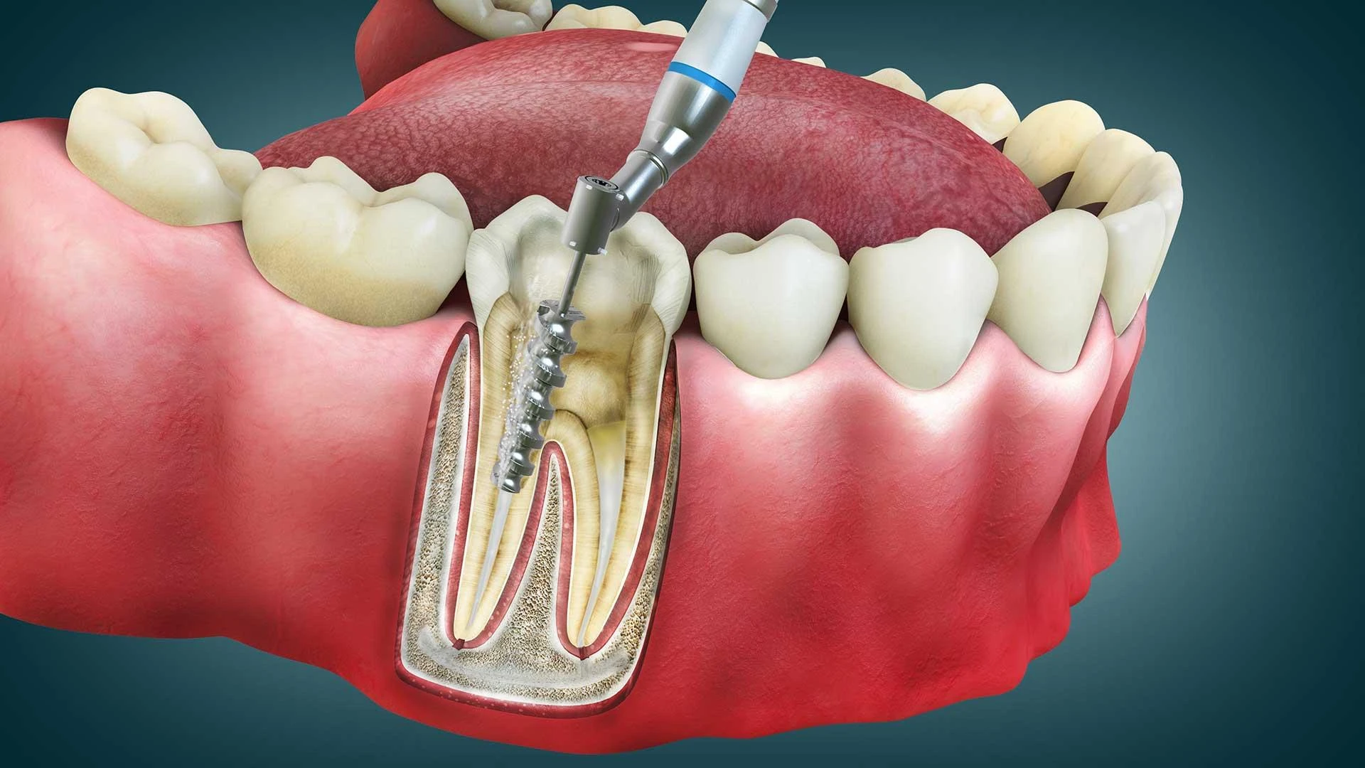 Is Root Canal Treatment Painful? Procedure, Cost & Recovery Explained