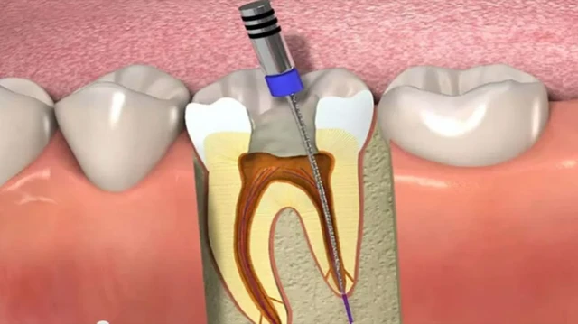 Root Canal Treatment: Your Path to Pain Relief