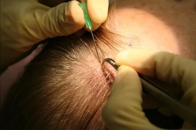 How Many Grafts Do You Really Need for Natural Results?