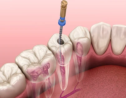 Endodontics Treatments vs Tooth Extraction: Which Is Better?