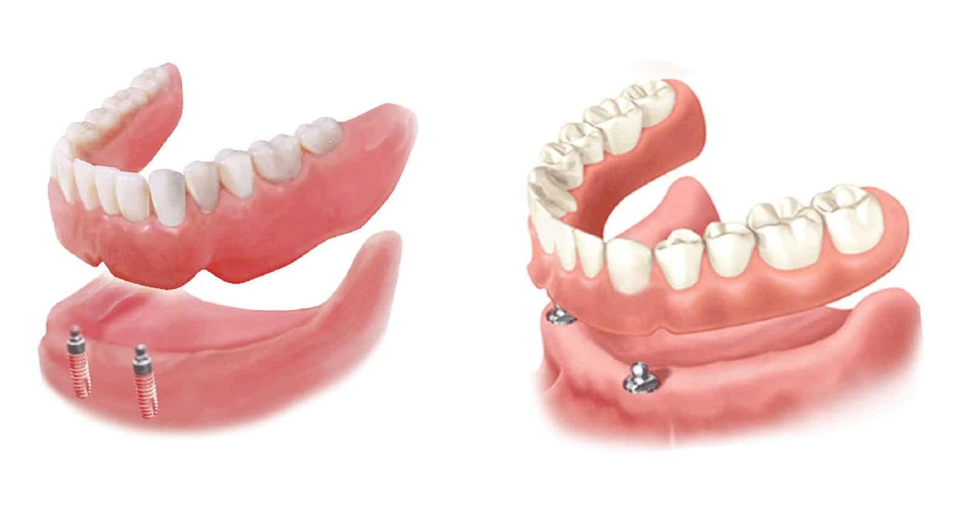 Are Overdentures Comfortable? What Patients Should Know