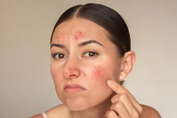 Monsoon Acne: Why Humidity Makes Breakouts Worse
