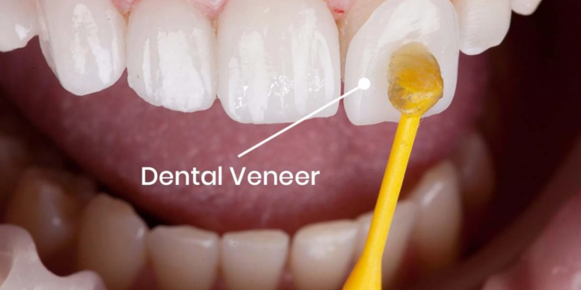 What Are Dental Veneers? – Enhance Your Smile with Confidence