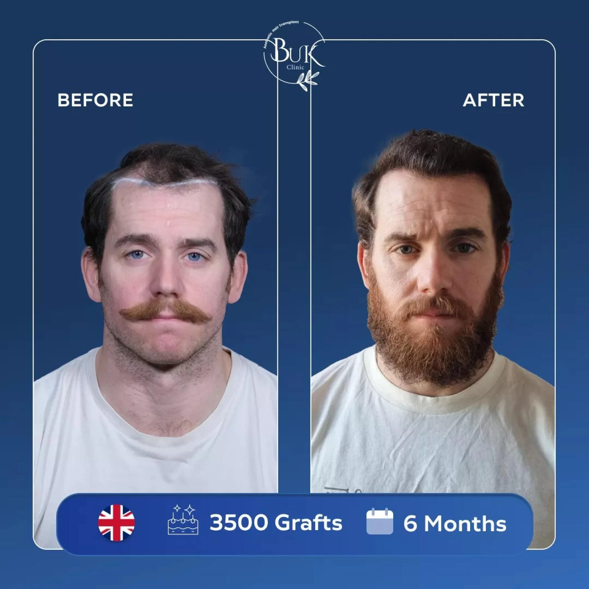 Hair Transplant Turkey: Planning Your Medical Trip