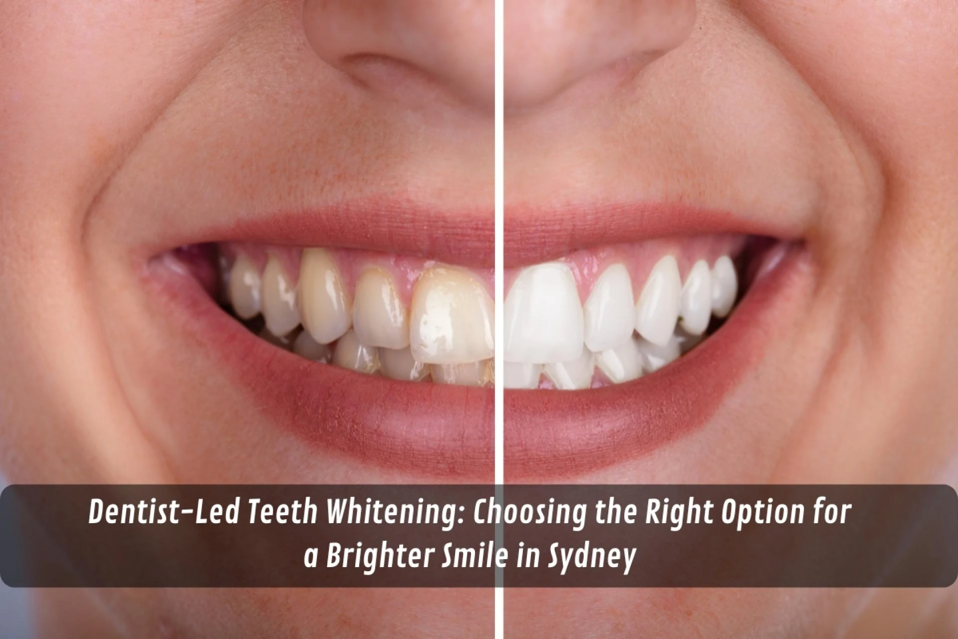 Dentist-Led Teeth Whitening: Choosing the Right Option for a Brighter Smile in Sydney