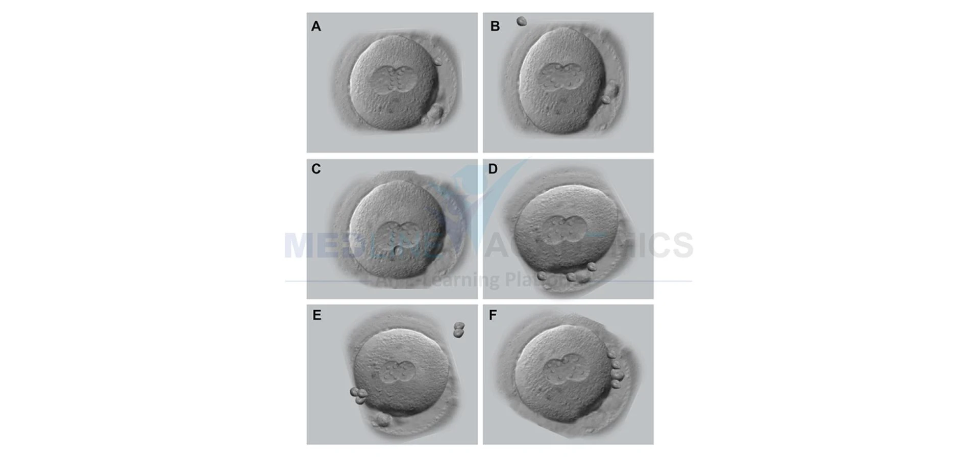Blastocyst Culture in IVF Is Not for Everyone: Embryology Courses in India
