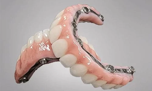 What’s Included in Full Mouth Implant Cost? Consultation, Surgery, and Final Teeth
