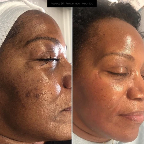 Dermaplaning: How This Tampa Treatment Transforms Dull Skin Into a Glow