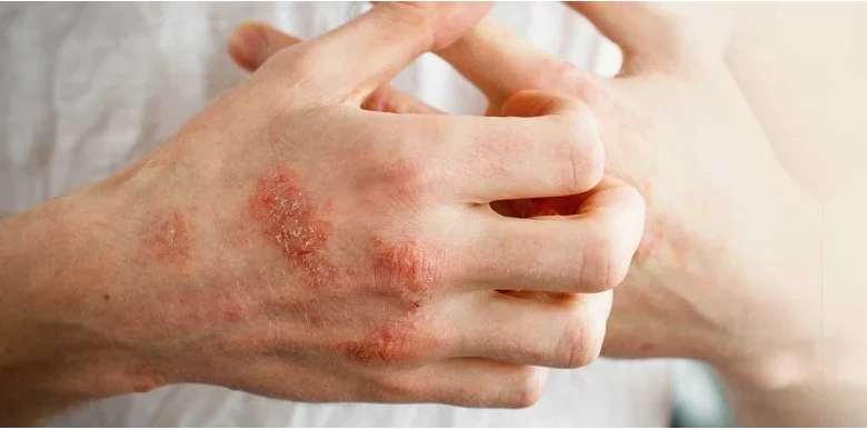 Struggling With Eczema Flare-Ups? What Makes Eczema Treatment in Bandra More Effective Today