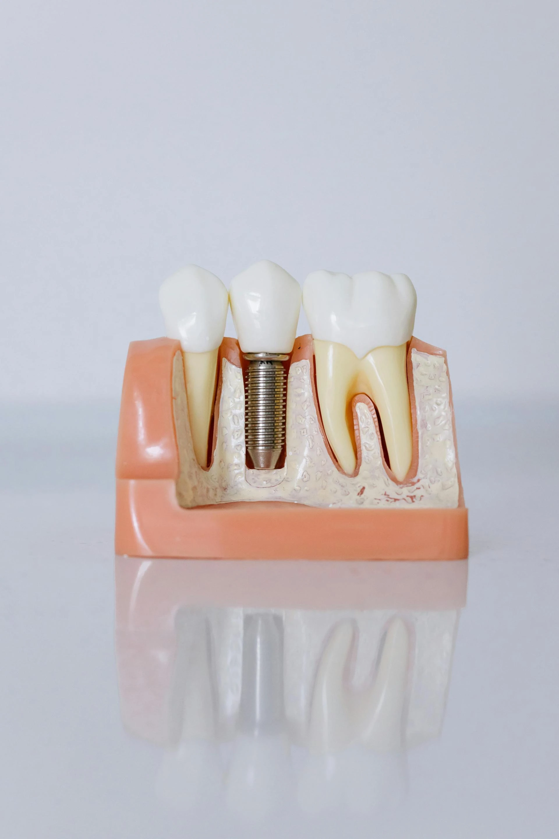Who Is the Best Implant Dentist in Seattle?