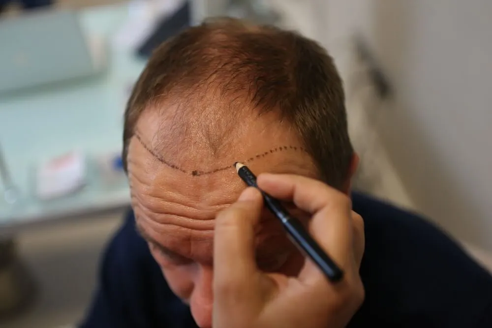 Hair Transplant Clinic HIV Positive: Safe and Advanced Hair Restoration Options