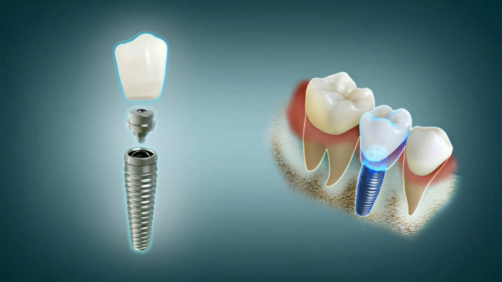 Dental Implants Cost, Procedure & Recovery: Everything You Need to Know Before Getting One