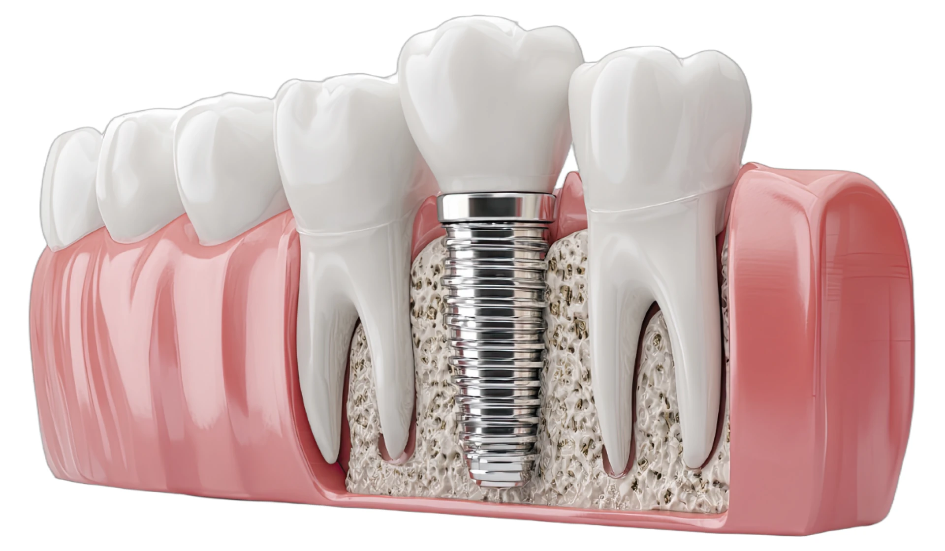 How to Know If Complete Dental Implants Are Right for You