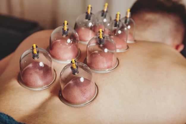 Traditional Chinese Medicine and the Role of Cupping Therapy