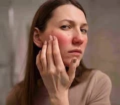 What is the new treatment for port wine stains?