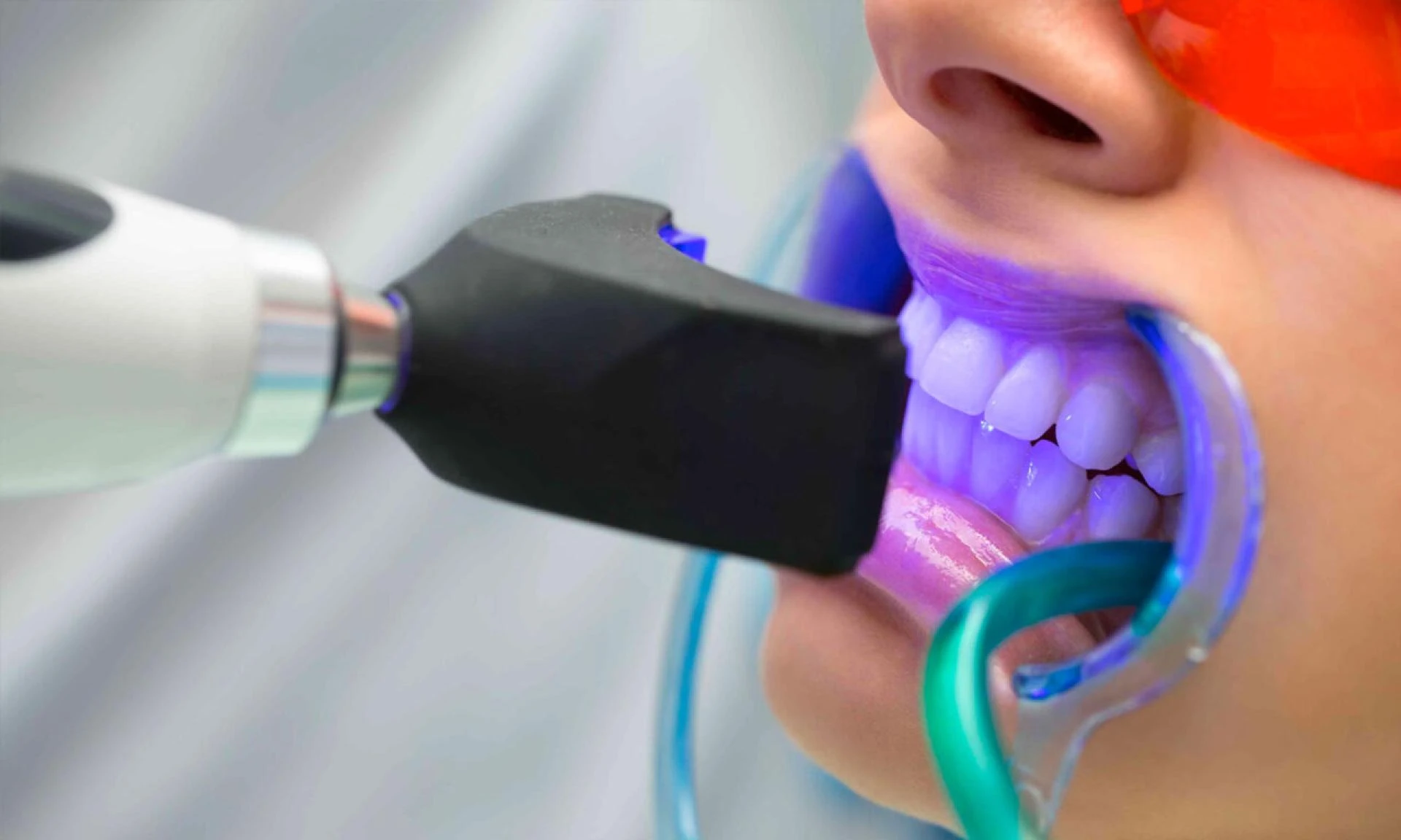 How Long Does Teeth Whitening Last? Expert Tips for a Brighter Smile