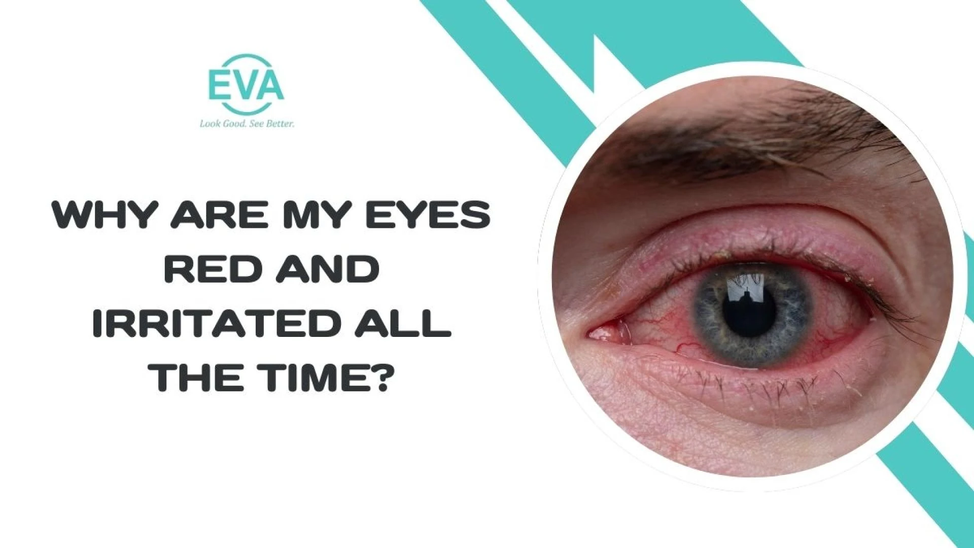 Why Are My Eyes Red and Irritated All the Time?