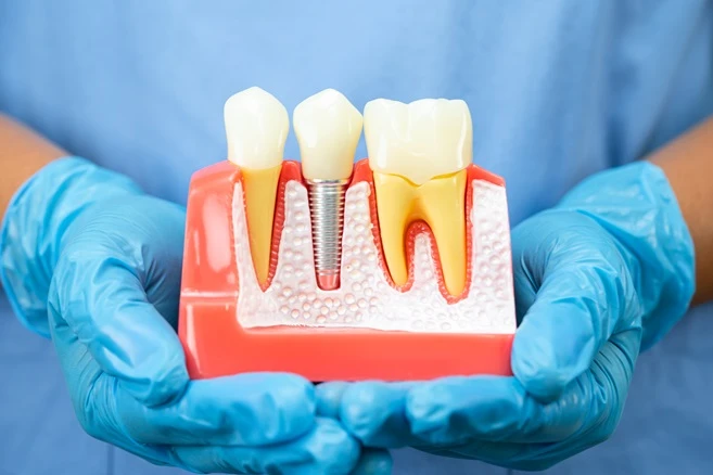 The Different Types of Dental Implants