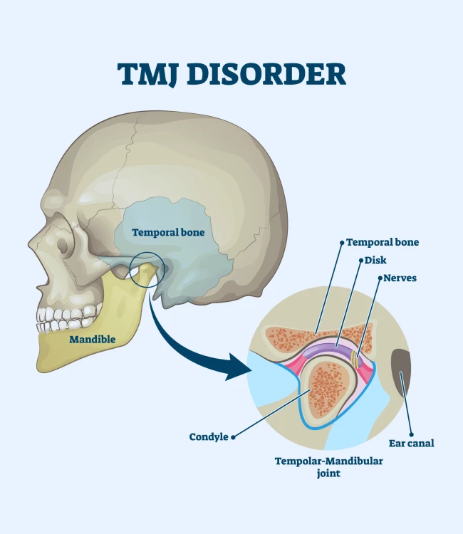 Understanding Headaches TMJ: Effective TMJ Disorder Treatment and Relief for Jaw Pain and Headaches in Dubai