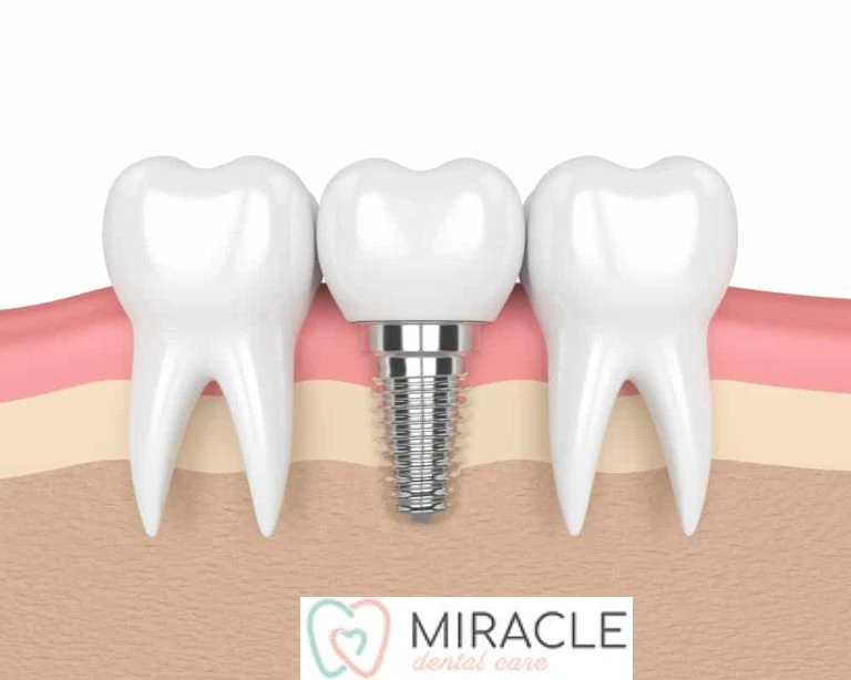 Miracle Dental Care – Your Local Family and Emergency Dentist for Campsie, Croydon Park, Dulwich Hill and Earlwood