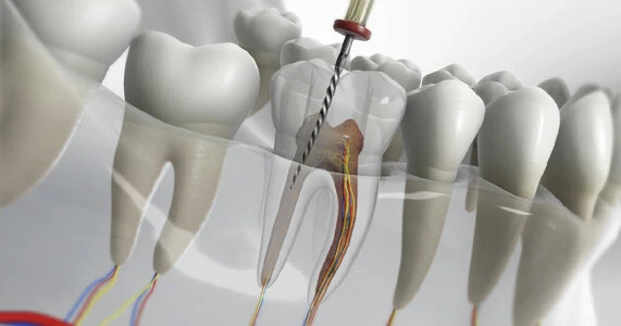 Why Consult an Experienced Endodontist in Nagpur for Complex Root Canal Cases?