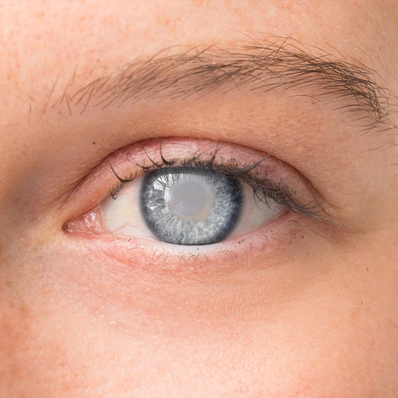 Your Guide to Cataract Treatment in Bangalore