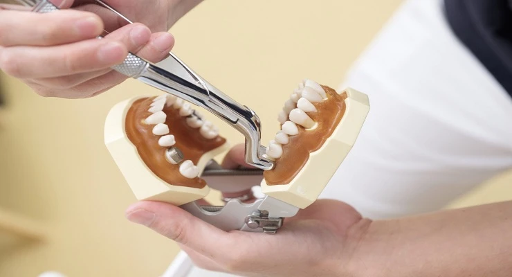 How Long Does It Take to Heal After an Extraction? Dr. Sun Kim’s Guide