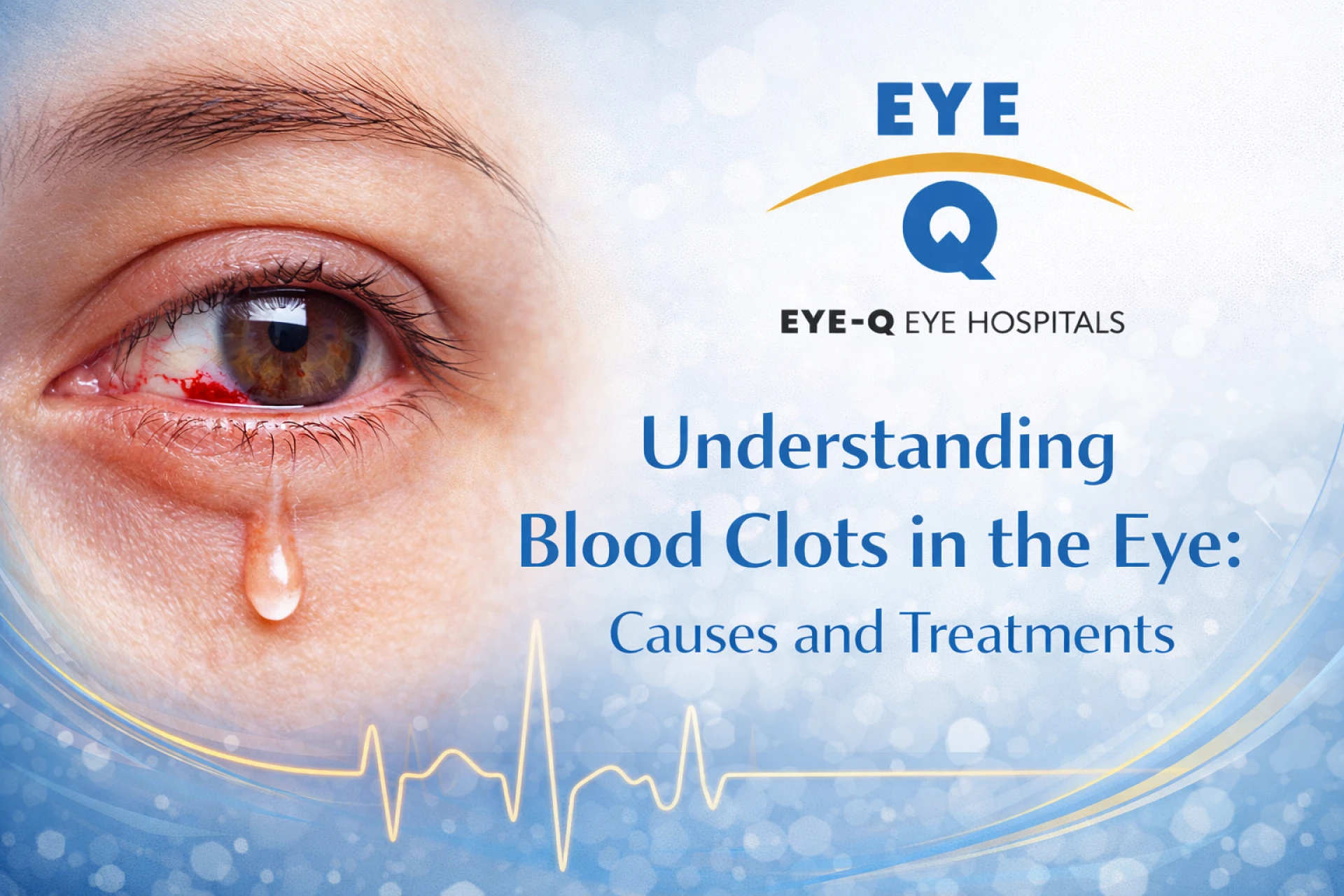 Understanding Blood Clots in the Eye: Causes and Treatments