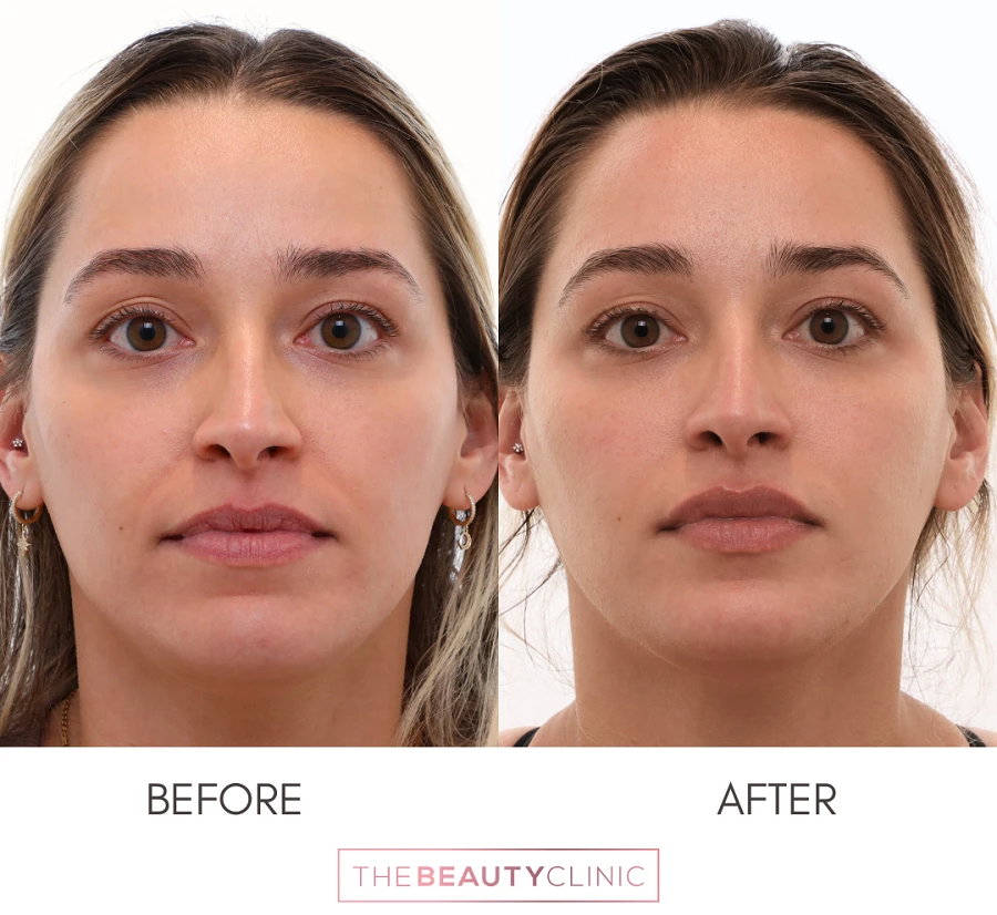 Analyzing PRF EZ Gel Before-and-After Results for Natural Facial Volume