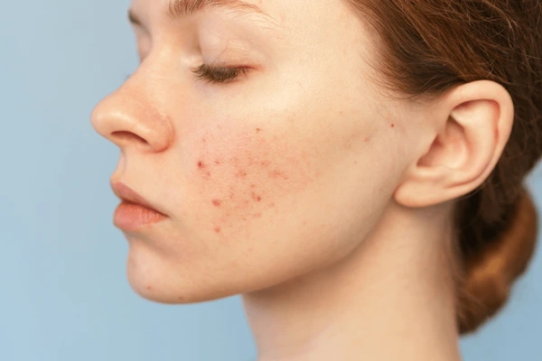 The Microbiome Shift: How Skin Bacteria Influence Acne and Skin Balance