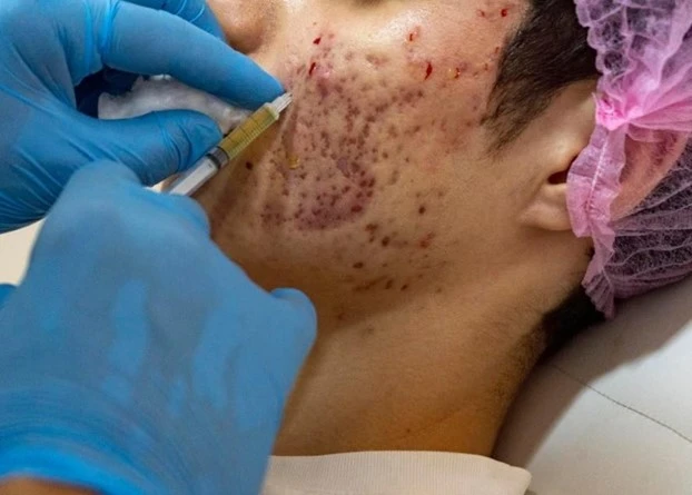 Dermaplaning Facial: How It Works and Its Benefits for Smooth Skin