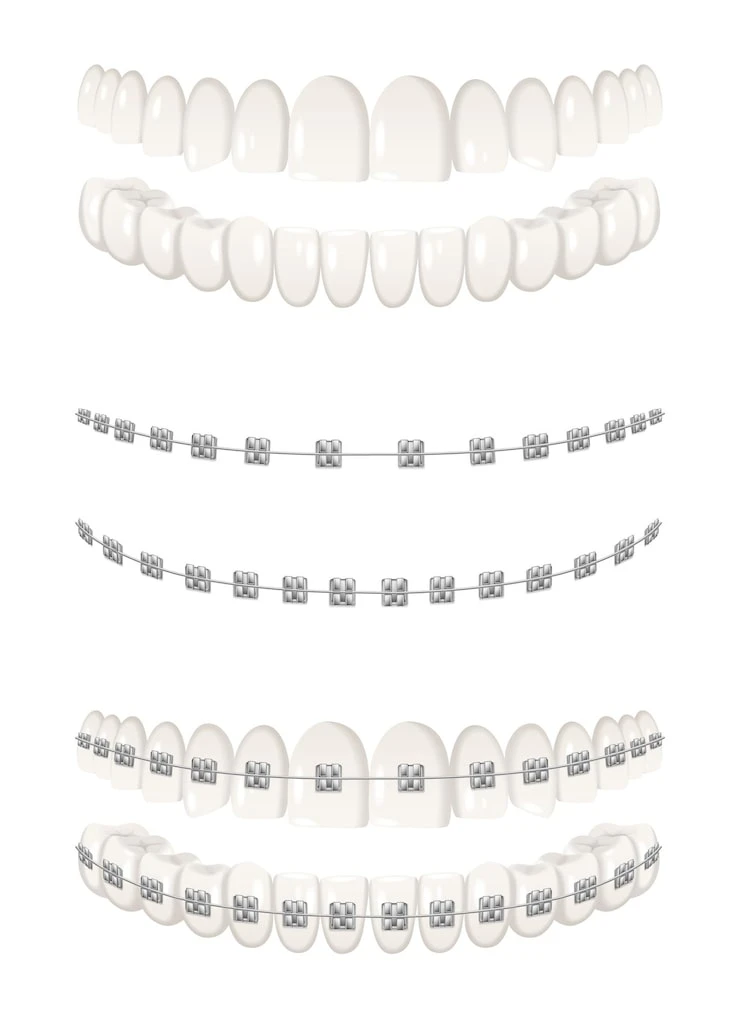 Anaheim Invisalign vs Braces: Benefits, Differences, and What to Choose
