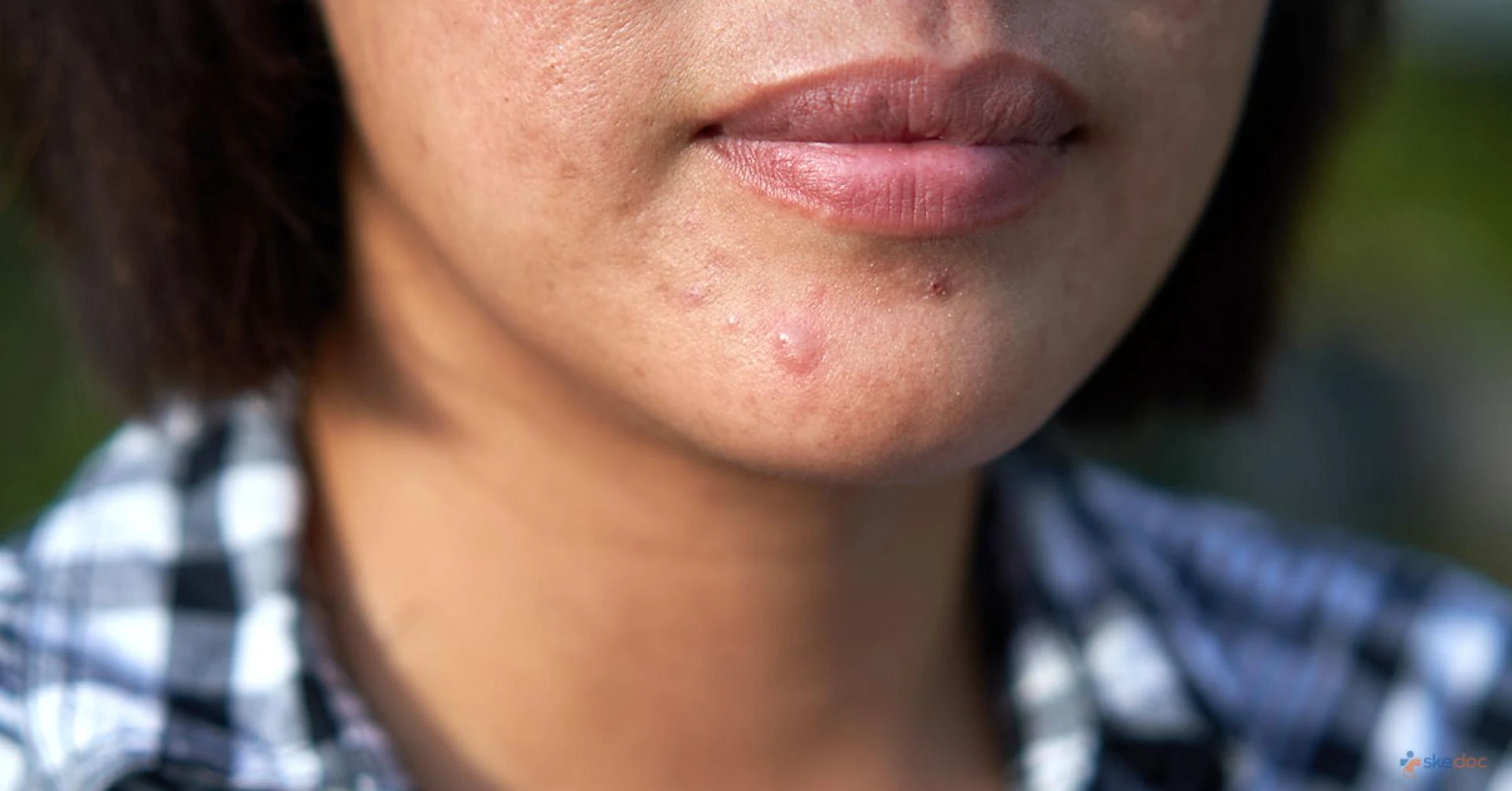 The Oxygen Deprivation Theory: How Low Oxygen Zones on Skin May Trigger Acne