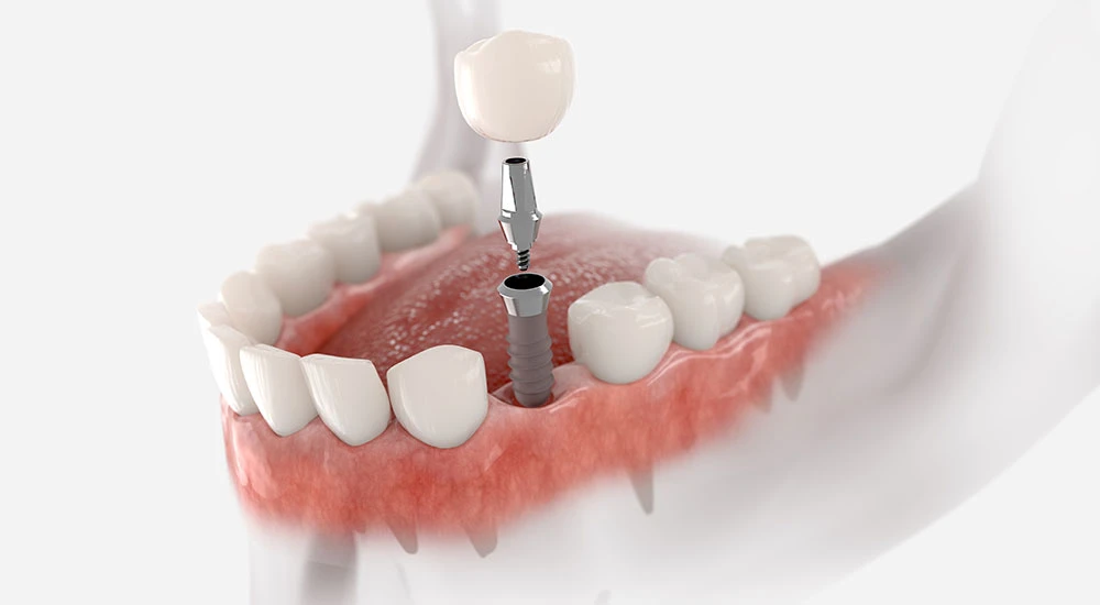 How to Get Dental Implants at a Reasonable Cost Without Compromising Quality