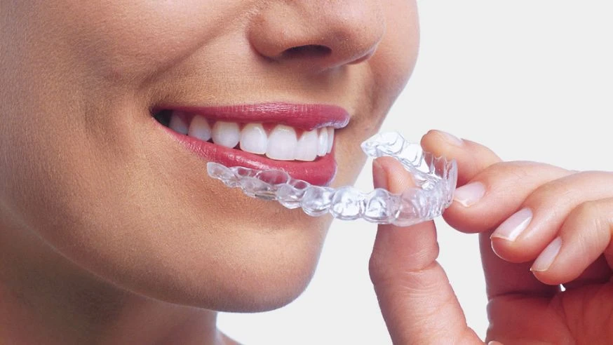 What Are Invisible Braces? A Complete Beginner's Guide to Clear Aligner Therapy