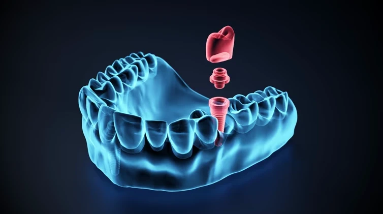 Best Dental Clinic in Antalya Smile Makeover Guide for International Patients