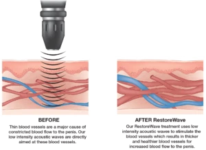 Learning About Acoustic Wave Therapy for ED Treatment
