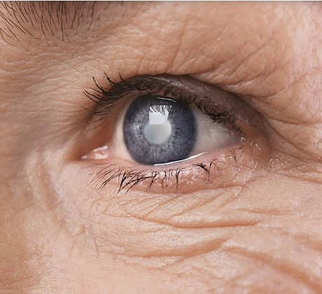 Modern Treatments for Dry Eye and Blepharitis: What Patients Should Know