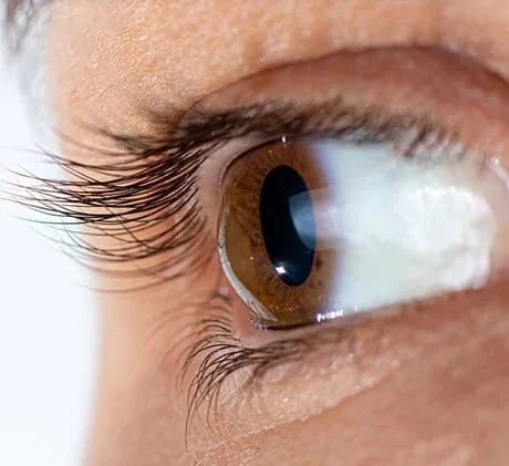 How CAIRS Technology Is Improving Keratoconus Treatment Outcomes