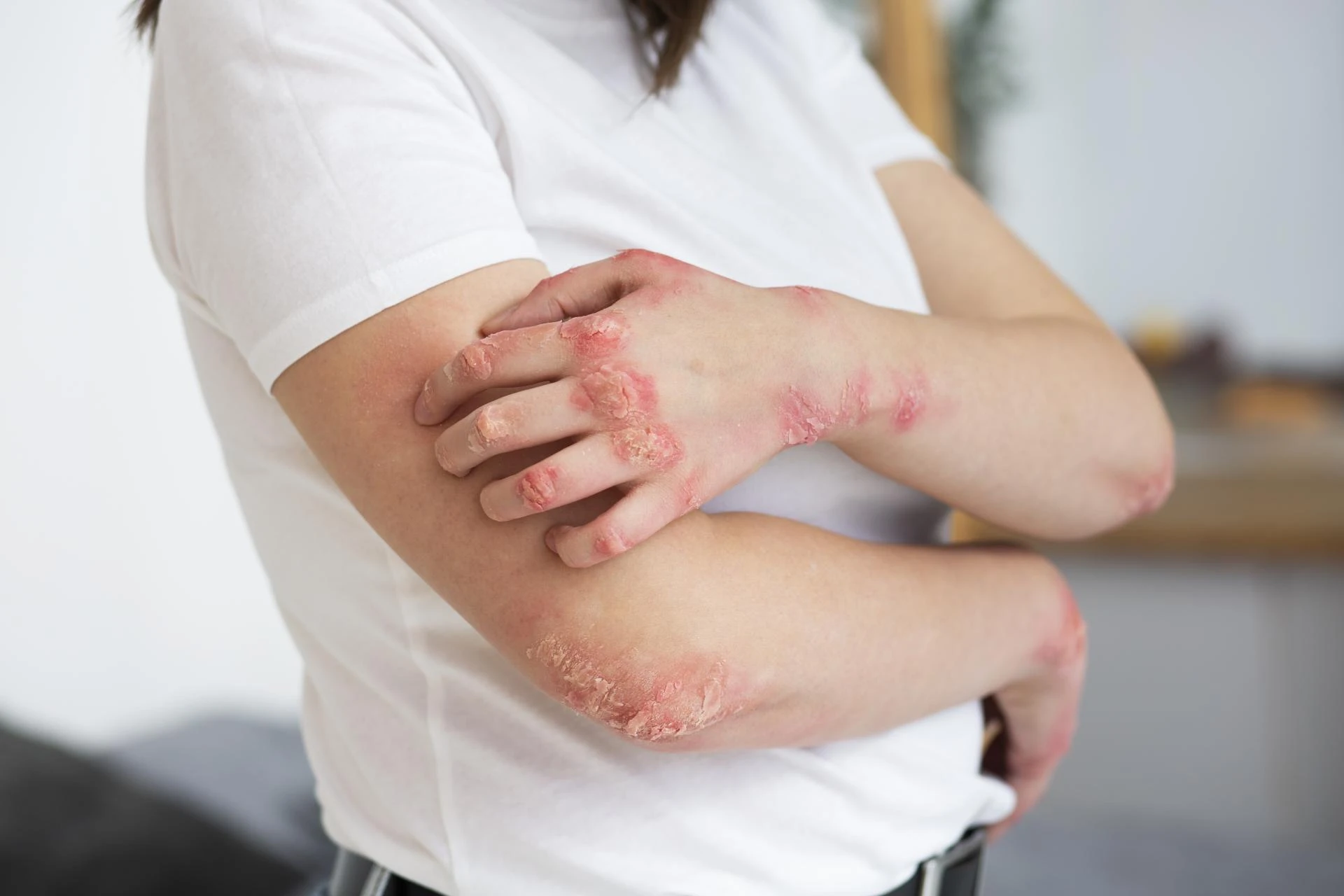How to Choose the Right Psoriasis Treatment for Skin?