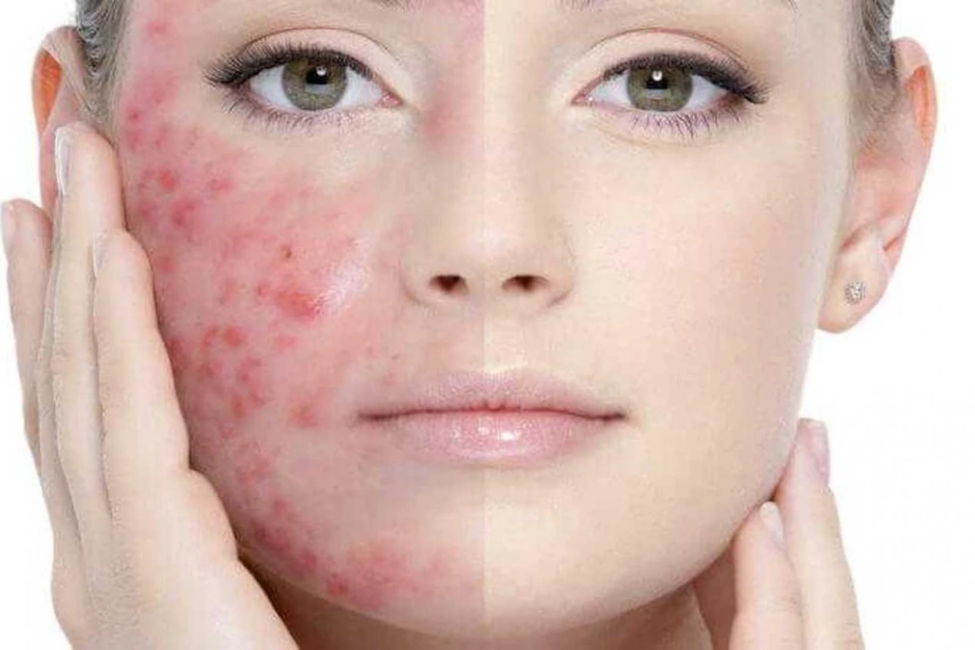 Why Adult Acne Behaves Differently Than Teenage Breakouts