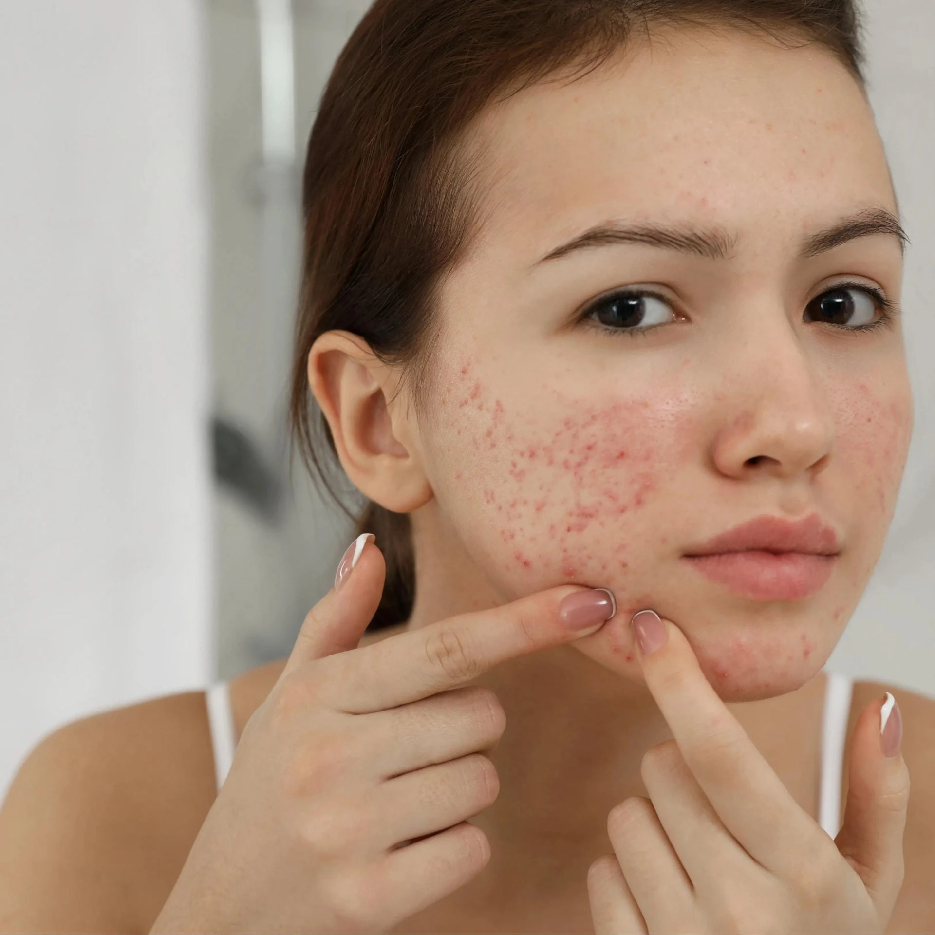 The Acne Cycle Explained: Why Pimple Treatment Needs to Target Root Causes