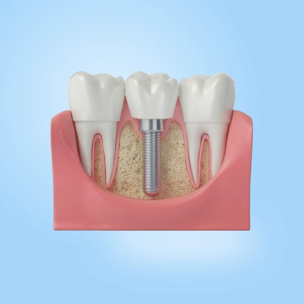 Are Dental Implants Better Than Removable Dentures?