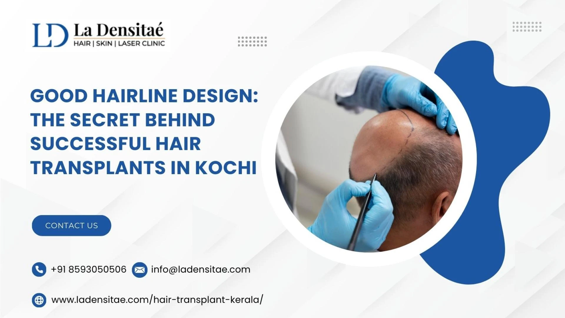 Good Hairline Design: The Secret Behind Successful Hair Transplants in Kochi