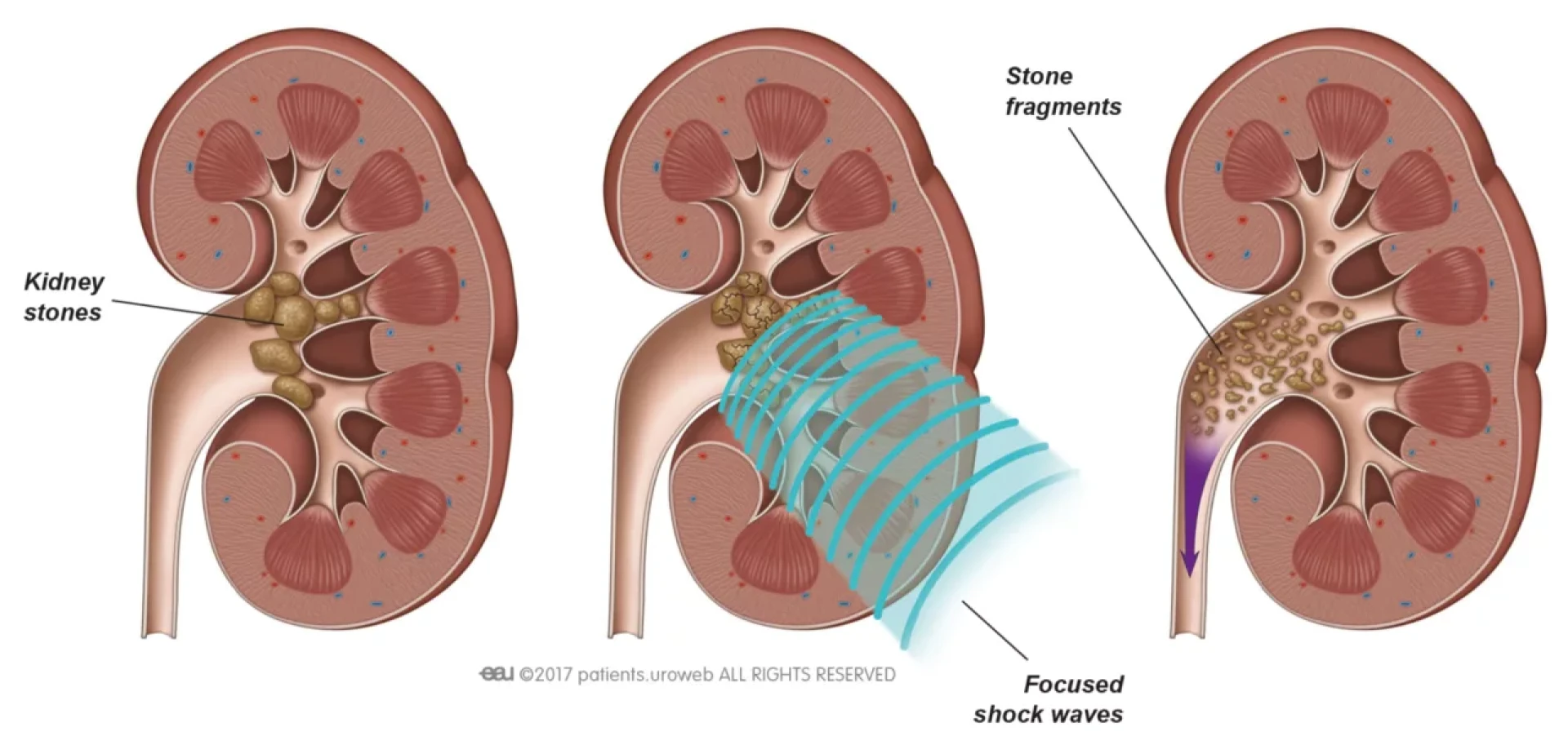 ESWL Treatment Cost and Recovery Time: A Complete Guide