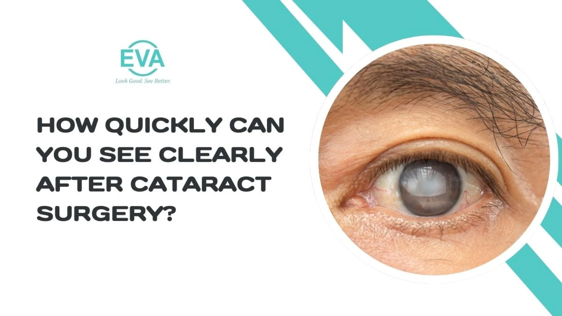 How Quickly Can You See Clearly After Cataract Surgery?