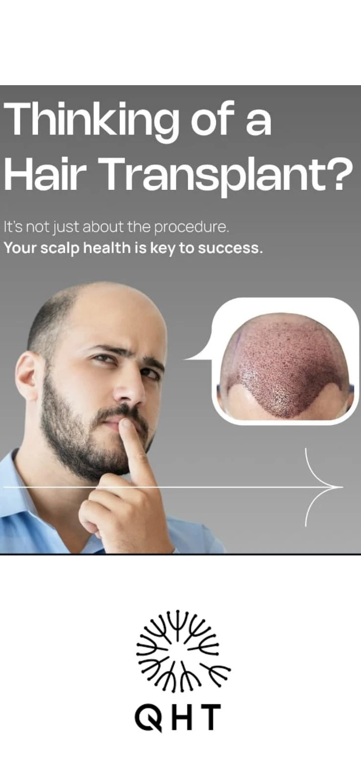 Hair Transplant and Alopecia Areata: What Delhi Patients With Patchy Hair Loss Need to Know